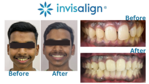 Read more about the article Transforming Smiles: A Case of Closing Gaps and Correcting Deep Bite with Invisalign