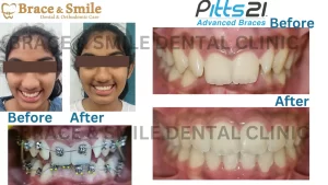 Read more about the article Before and After| pitts 21 braces | Crowding, Deep bite teeth correction without extraction of any teeth in just 7 months